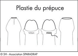 Schéma explicatif de la plastie du prépuce