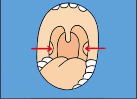 Schéma d'une bouche ouverte où sont indiquées les amygdales