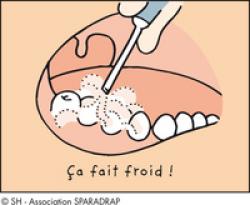 Action d'une soufflette sur des dents