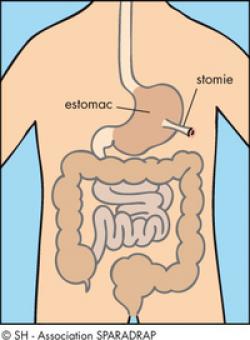 schéma de la gastrostomie